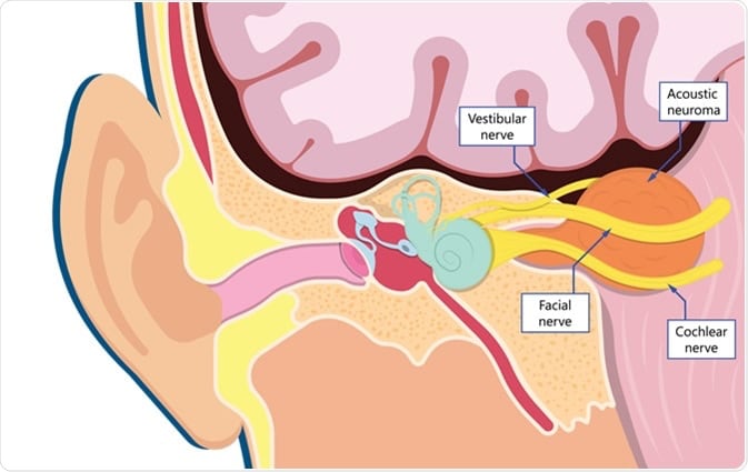 Acoustic Neuroma