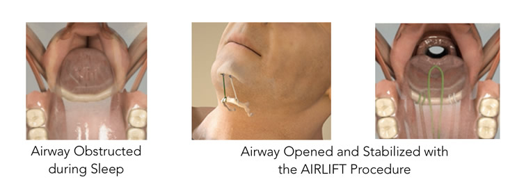 Airlift Imaged of airway obstructed during sleep and then opened and stabilized with Airlift
