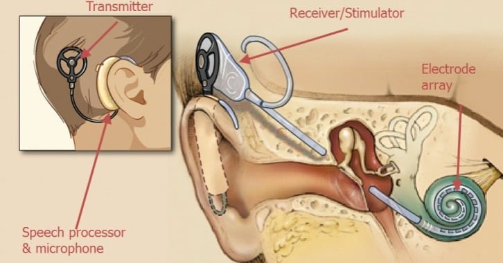 cochlear implant