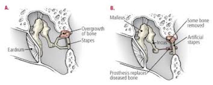 What Is Otosclerosis? Symptoms & Diagnosis