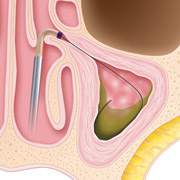 Balloon Sinuplasty - Step 1 Catheter is Inserted