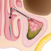 Balloon Sinuplasty - Step 2 Balloon is Inflated