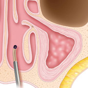 Balloon Sinuplasty - Step 4 System is Removed